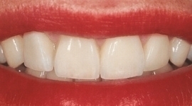 denti